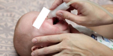 Berikan Obat Tetes Hidung, sebagai cara mengatasi hidung tersumbat pada bayi